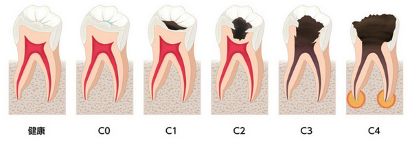 進行度合い別、虫歯ステージ図解