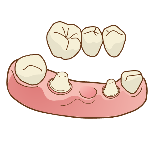 歯科治療　ブリッジ