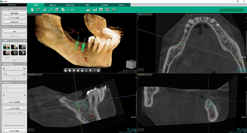 みどり歯科医院　インプラントのシミュレーション画像