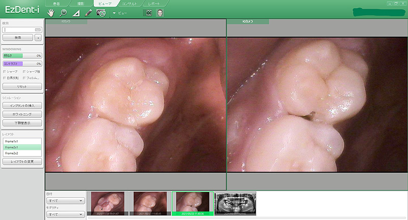 みどり歯科医院　口腔内カメラ画像