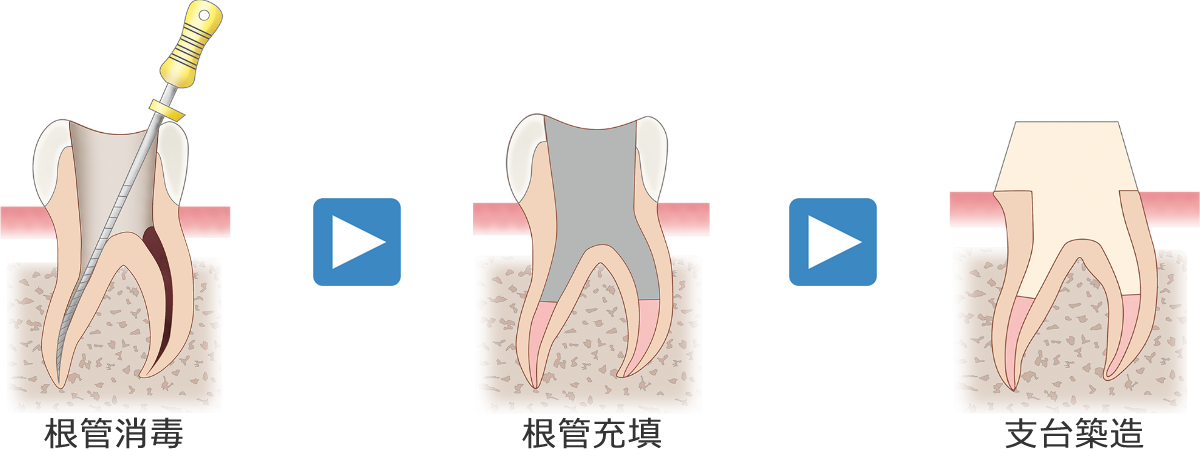 深く神経にまで達する虫歯（C3） → 歯根内の消毒（根管治療）の後、クラウンを被せます