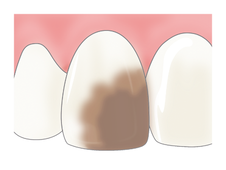 狭い範囲の虫歯（C1～2）