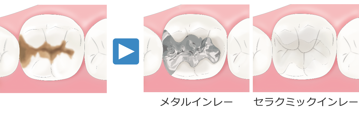 型をとってメタルインレー・セラクミックインレー（部分的な詰め物）やクラウン（全体の被せ物）をはめます。