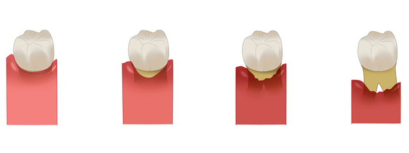 歯周病の治療