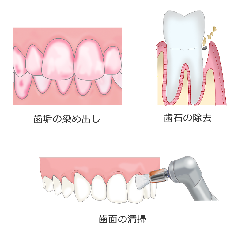 歯周病ケア、歯のクリーニング